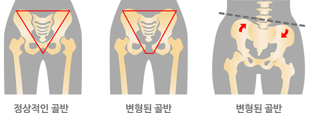 골반1.png